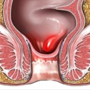 Hemmoroider - House Treatment Methods For Treating Uncomfortable Piles