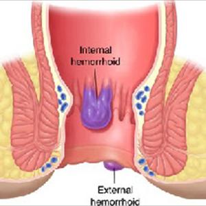 Hemorroidal Relief - Hemorrhoids Driving You Crazy? Get Help Here!