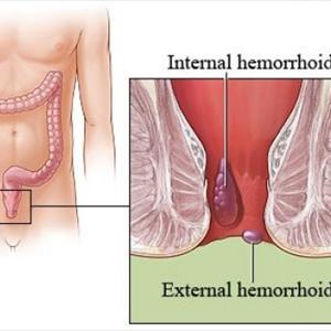 Hemroid Blood Clot - Hemorrhoids Driving You Crazy? Get Support Here!