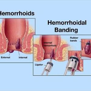 Sulfur Hemmorhoid Treatment - Recommendations On How To Handle Piles