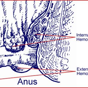 Home Hemorrhoid Cures - Worried About Piles? Below Are A Few Answers